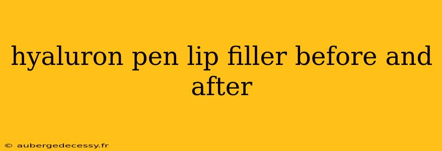 hyaluron pen lip filler before and after